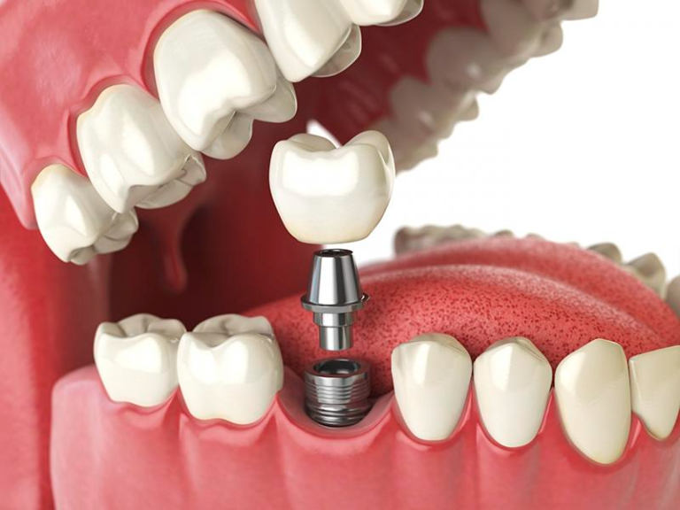 Trồng răng implant có tốt không